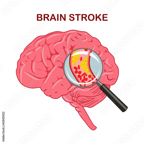A stroke, sometimes called a brain attack, occurs when something blocks blood supply to part of the brain or when a blood vessel in the brain bursts. 