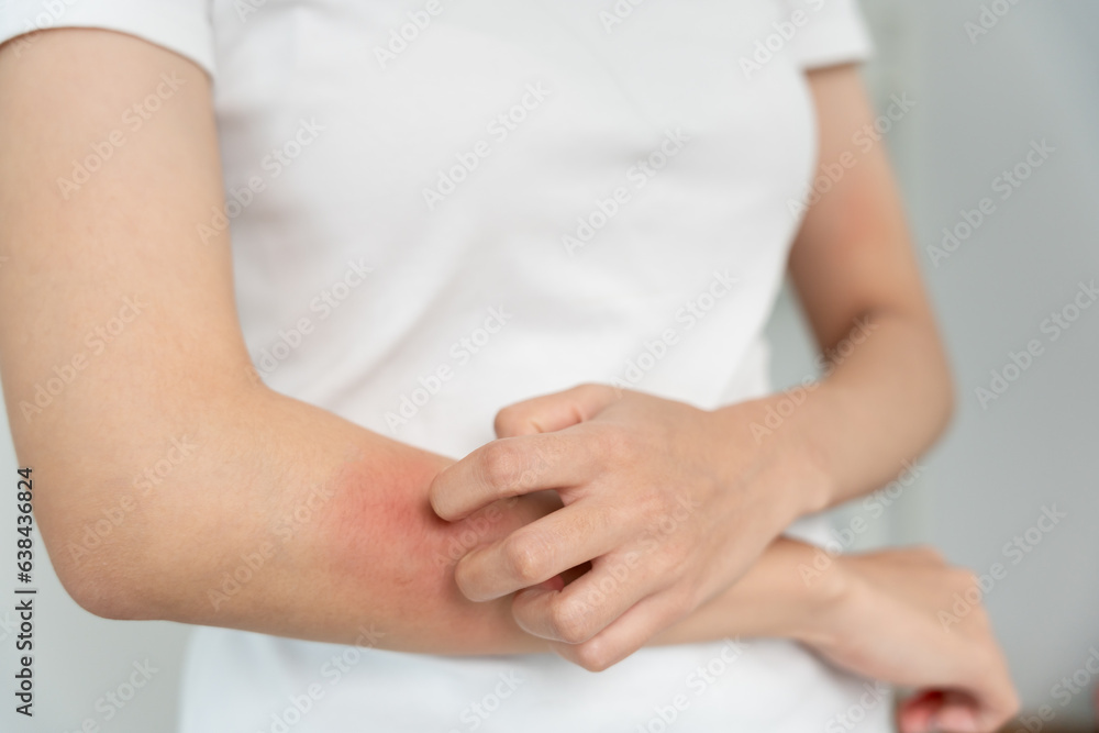 skin problem and beauty. Young woman scratch body has itchy skin from skin allergic, steroid allergy, sensitive skin, red from sunburn, chemical allergy, rash, insect bites, Seborrheic Dermatitis. skin problem and beauty. Young woman scratch body has itchy skin from skin allergic, steroid allergy, sensitive skin, red from sunburn, chemical allergy, rash, insect bites, Seborrheic Dermatitis.