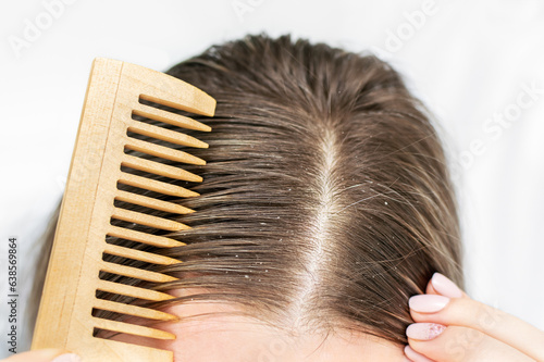 Female with wooden hairbrush close-up. Young woman with dandruff problem and itchy head. White flakes on the hair. Disease seborrhea. Dry skin problem. photo