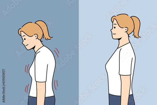 Stooped woman before and after correcting posture thanks to massage therapist or chiropractor helping to get rid of scoliosis. Girl with bad posture due to lordosis and kyphosis or spinal defect