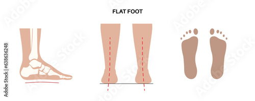 Flat feet anatomy