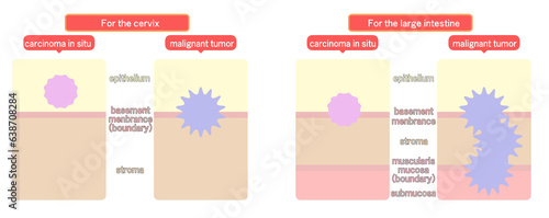 上皮内新生物と悪性新生物の違い photo