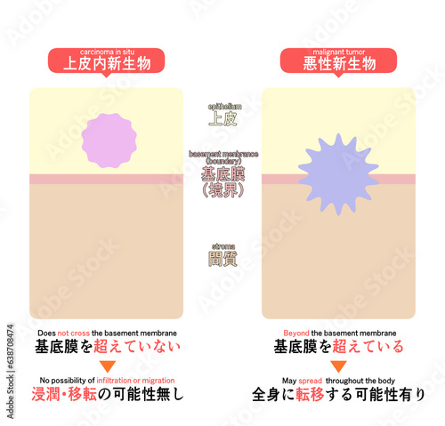 上皮内新生物と悪性新生物の違い