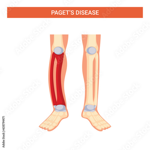 Paget's disease human body posture vector