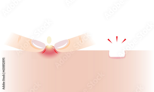 Squeezing acne to boxcar scar vector illustration on white background. The inflammatory acne, pustule, nodule, cyst on skin, popping pimple with fingers to acne scar. Before and after concept.