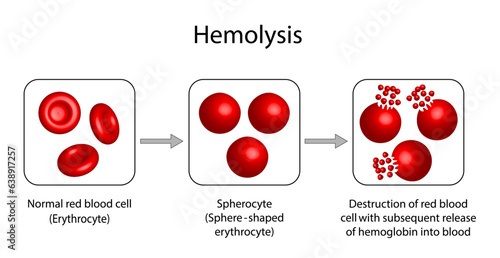 Hemolysis. Normal red blood cell, spherocyte, then destruction of red blood cell with subsequent release of hemoglobin into blood. Vector illustration