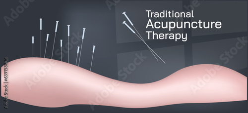 Acupuncture is the practice of penetrating the skin with thin, solid, metallic needles which are then activated through gentle and specific movements of the practitioner's hands vector illustration.