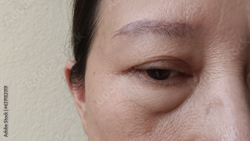 Middle-aged women have wrinkles on their faces, acne, freckles, scars on their faces.
