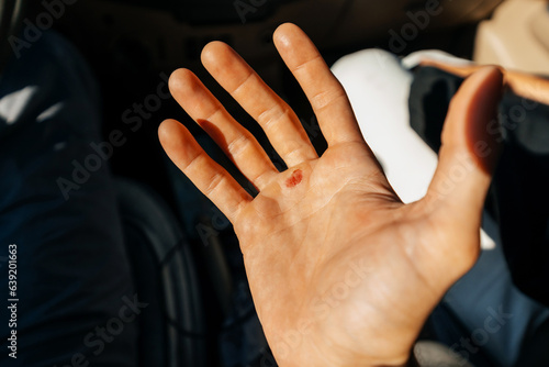 torn corn on the hand of a man. damage to the skin on the palm of the guy. lack of a protective piece of skin on the hands