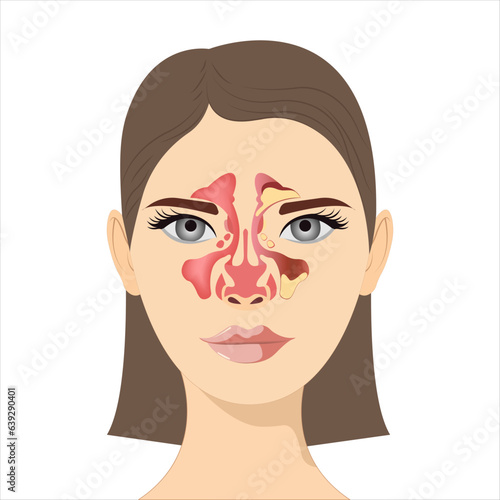 Sinusitis,  Female face with inflammation of the mucous membrane of the paranasal and frontal sinuses. Vector illustration for medical posters and educational materials