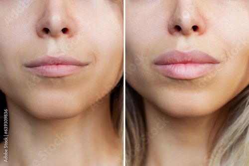 Result of lip augmentation. Cropped shot of young blonde woman's lower part of face with lips before and after lip enhancement. Injection of filler in lips. Difference, comparison photo