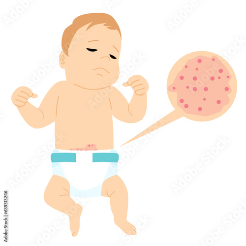 Vector illustration of baby child with diaper rash allergic itching. Heat reaction irritation on skin. Inflammation and dermatological problems