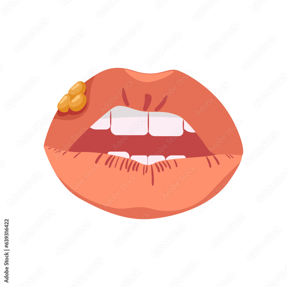 Lips with herpes. Infectious disease affecting mucous membranes in form of blisters with inflammatory ulcerative vector processes Lips with herpes. Infectious disease affecting mucous membranes in form of blisters with inflammatory ulcerative vector processes