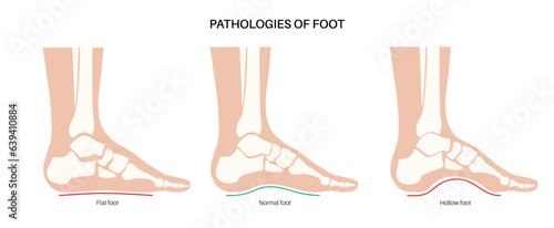 Foot pathologies poster