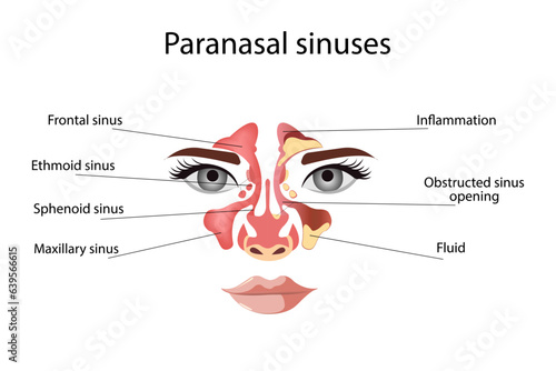 Sinusitis,  Female face with inflammation of the mucous membrane of the paranasal and frontal sinuses. Vector illustration for medical posters and educational materials
