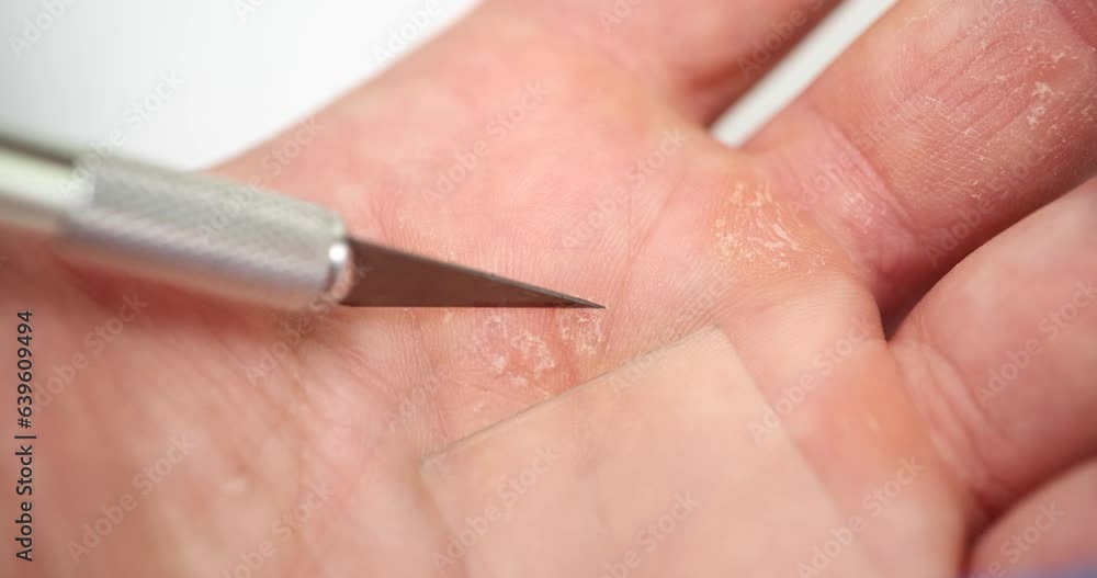 Dermatologist takes skin scraping for analysis. Male fingers with