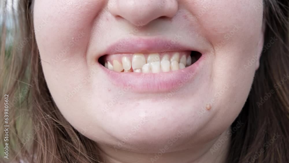 Patient woman with dislocated jaw and malocclusion, temporomandibular
