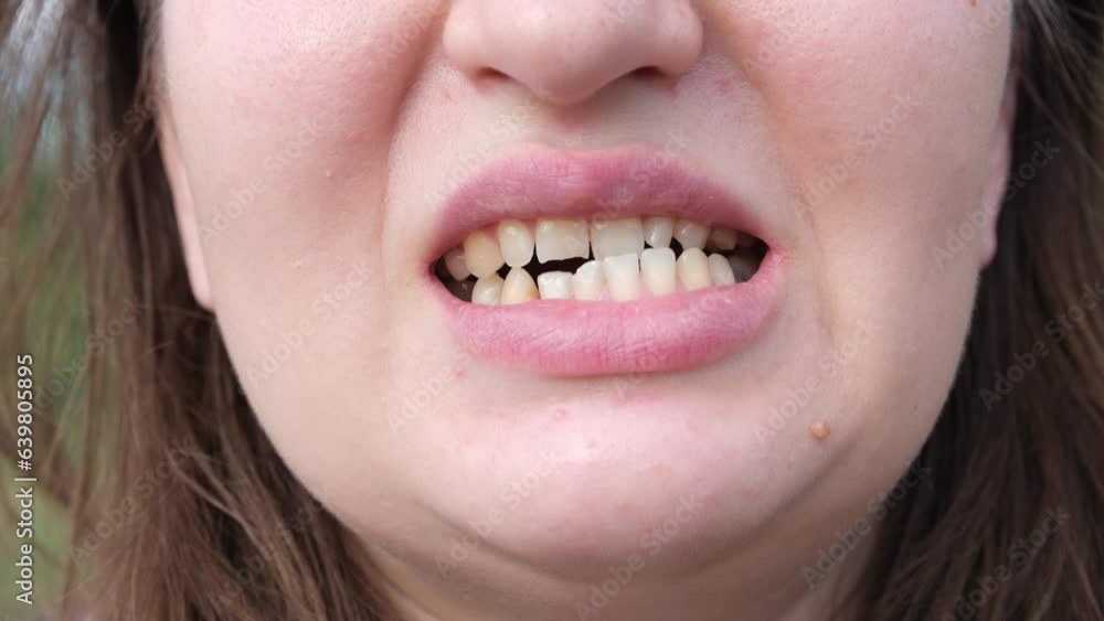 Patient woman with dislocated jaw and malocclusion, temporomandibular