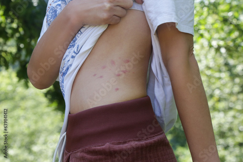 Red, swollen and itchy spots on skin caused by insect bites or allergy. Skin reaction to insect bites. photo