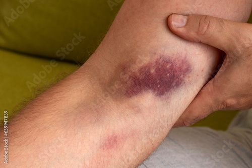Male hand with a large hematoma. Consequence of the injection.