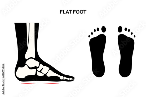 Flat feet anatomy