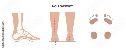 Hollow feet anatomy