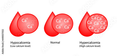 Hypercalcemia, high plasma calcium level and hypocalcemia, low plasma calcium level. Calcium excess and deficit electrolyte disorders, blood droplet, Scientific design. Vector illustration. photo