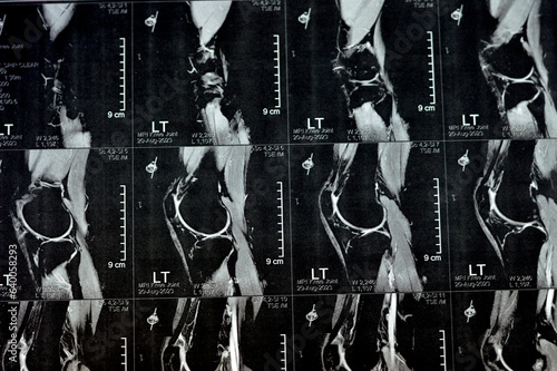MRI of left knee joint showing minimal joint effusion, PHMM Posterior Horn Medial Meniscus degeneration, ACL anterior cruciate ligament mild sprain, normal MCL, LM, LCL, ligaments, vessels and nerves photo