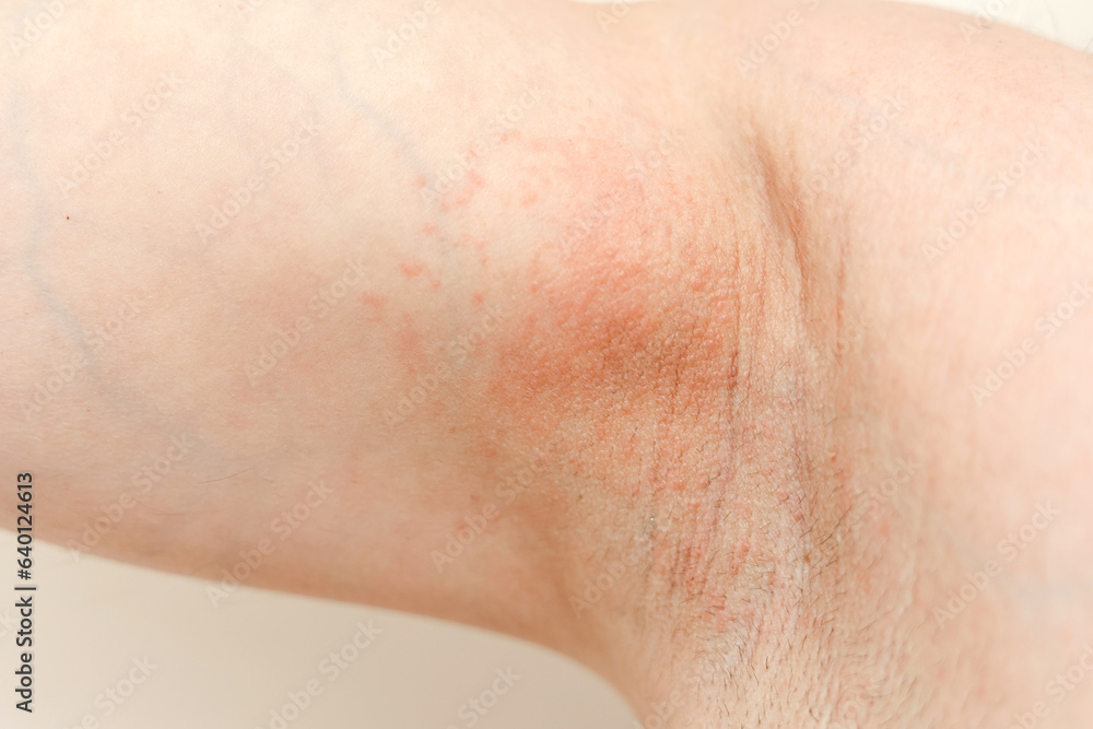 Allergy underarm. Cropped photo of irritation, inflammation on the sensitive skin after using a razor, trimmer, toxic deodorant or antiperspirant. Armpit rash. Atopic dermatitis. Acne or red spots.