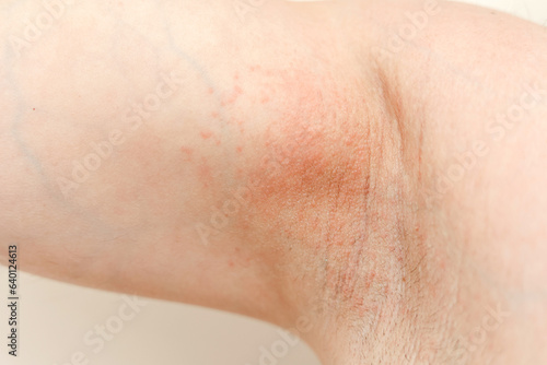 Allergy underarm. Cropped photo of irritation  inflammation on the sensitive skin after using a razor  trimmer  toxic deodorant or antiperspirant. Armpit rash. Atopic dermatitis. Acne or red spots.