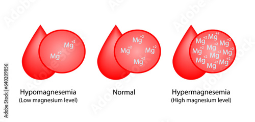 hypermagnesemia, high plasma magnesium level and hypomagnesemia, low plasma magnesium level. magnesium Mg excess and deficit electrolyte disorders, blood test tube, Scientific vector