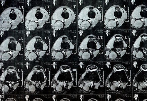 MRI of left knee joint showing minimal joint effusion, PHMM Posterior Horn Medial Meniscus degeneration, ACL anterior cruciate ligament mild sprain, normal MCL, LM, LCL, ligaments, vessels and nerves photo