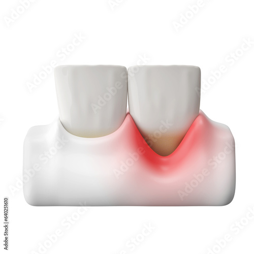 front teeth and gums recession or gingivitis 3D rendering. photo