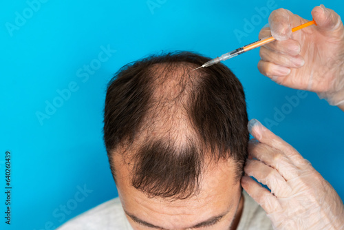 A doctor with a syringe in gloves making an injection to a man with alopecia on a blue background close-up.