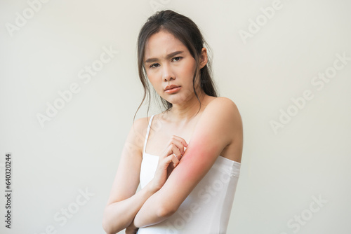 Dermatology asian young woman, girl allergy, allergic reaction from atopic, insect bites on her arm, hand in scratching itchy, itch red spot or rash of skin. Healthcare, treatment of beauty.