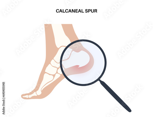 Heel spur poster