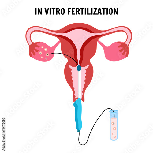 In vitro fertilization egg retrieval IVF 