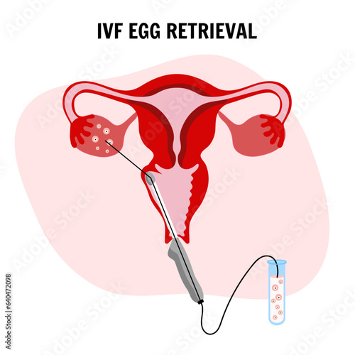 In vitro fertilization egg retrieval IVF 