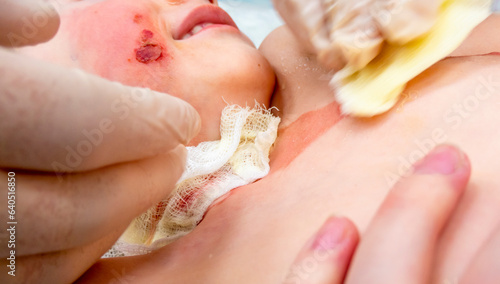 Obraz na płótnie medical procedure dressing a boy with a first-degree burn from boiling water on his face, neck and chest w salonie