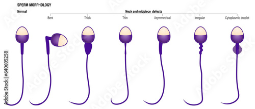 Normal with Neck and midpiece defects spermatozoon. Semen analysis vector. Sperm morphology. Male reproductive system.