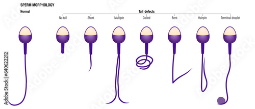 Normal and Tail defects spermatozoon. Semen analysis vector. Sperm morphology. Male reproductive system.