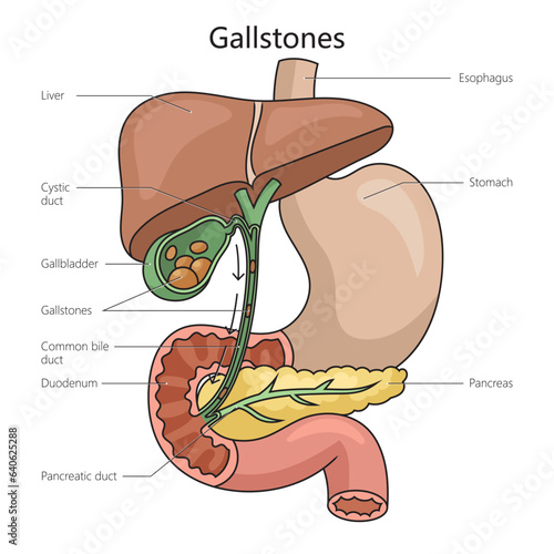 Gallstone stone formed within gallbladder from precipitated bile structure diagram schematic vector illustration. Medical science educational illustration