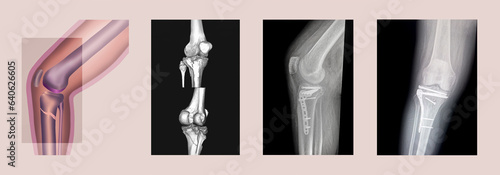 Structure of knee and rx-ray image of knee, tibia fracture with post operation internal fixation. photo