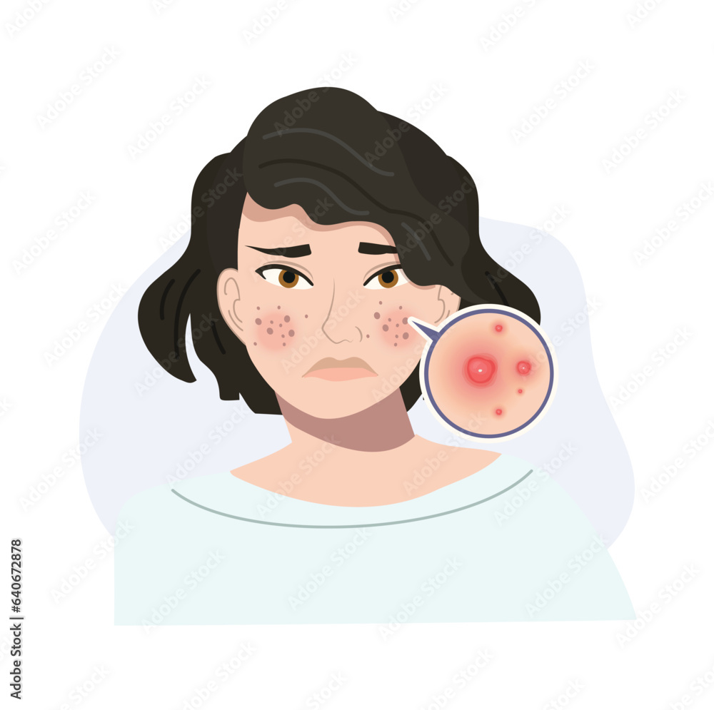 Portrait of Stressed Female with Troubled Skin. Acne, Cystic Skin Close Up. Flat vector cartoon illustration Portrait of Stressed Female with Troubled Skin. Acne, Cystic Skin Close Up. Flat vector cartoon illustration