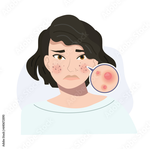 Portrait of Stressed Female with Troubled Skin. Acne, Papule Skin Close Up. Flat vector cartoon illustration
