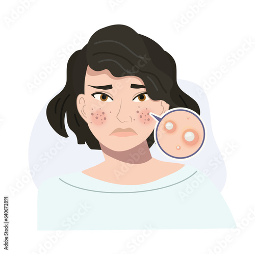 Portrait of Stressed Female with Troubled Skin. Acne, Whitehead Skin Close Up. Flat vector cartoon illustration