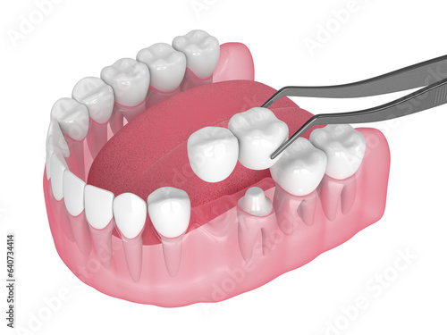 3d render of  jaw with dental cantilever bridge on embedded tooth
