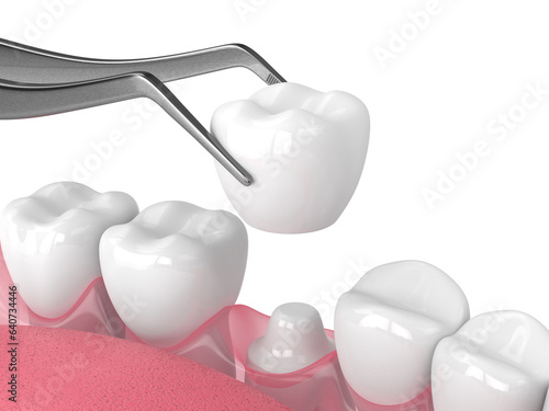 3d render of crown replacement on reshaped tooth