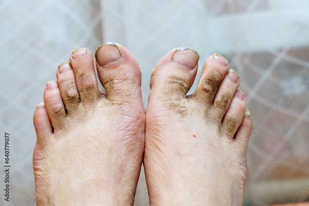 Fototapeta premium A view of dirty unkempt feet and dirty nails without a pedicure