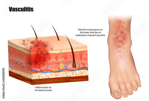 Vasculitis involves inflammation of the blood vessels. Petechia and purpura on the lower limb due to medication-induced vasculitis. Lymphangitis